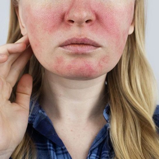 Redness Skincare