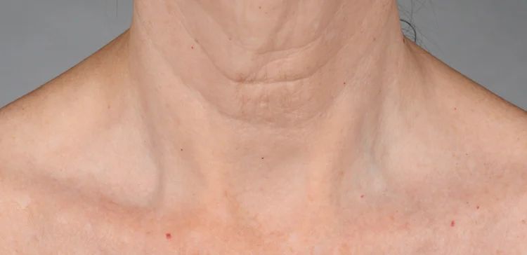 iS Clinical Neckperfect after