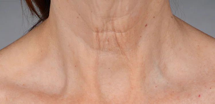 iS Clinical Neckperfect before