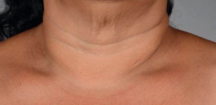 iS Clinical Neckperfect after