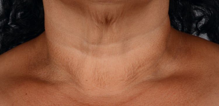iS Clinical Neckperfect before
