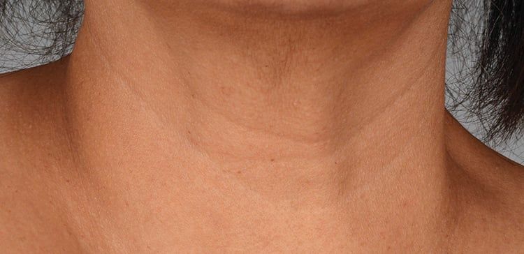 iS Clinical Neckperfect after
