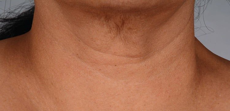 iS Clinical Neckperfect before