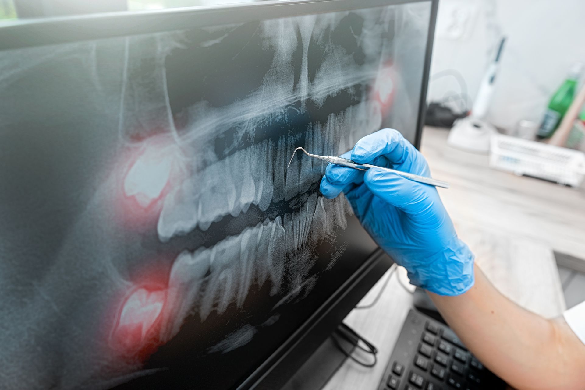 Mano guantata che contrassegna radiografie dentali su un monitor di computer in un ambiente clinico
