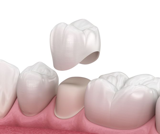 Una corona dentale viene posizionata su un dente.