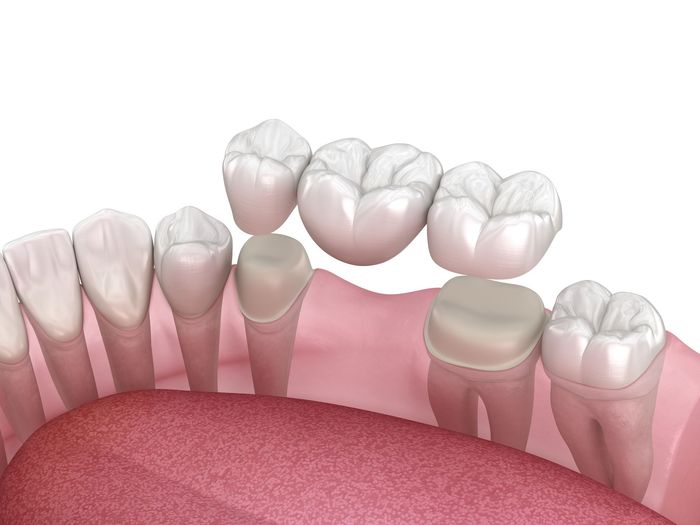 Un'immagine generata al computer di un ponte dentale in una bocca.