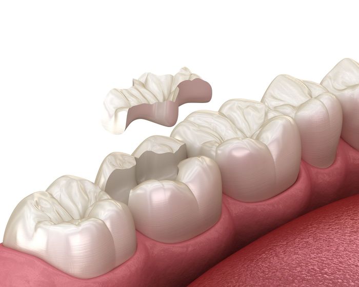Un'immagine generata al computer di un dente con un'otturazione.