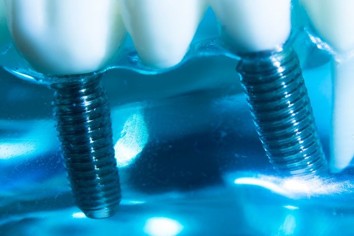 Primo piano di due impianti dentali con corone bianche su sfondo blu.