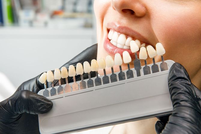 Scala cromatica dentale tenuta vicino a una bocca sorridente con mani guantate di nero