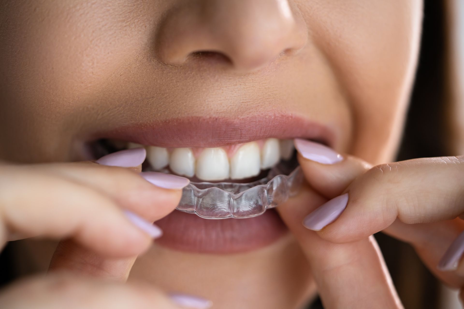 Mani che inseriscono un allineatore dentale trasparente in una bocca sorridente (primo piano)