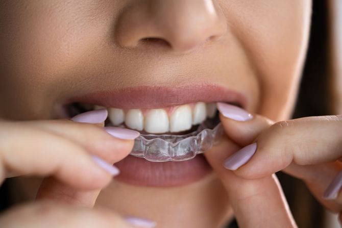 Una donna sta mettendo un apparecchio trasparente ai denti.