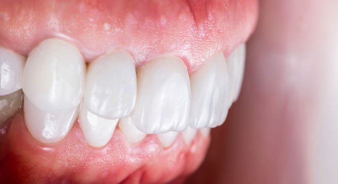 Primo piano dei denti e delle gengive di una persona, che mostra una vista laterale della bocca con denti bianchi e gengive rosa.