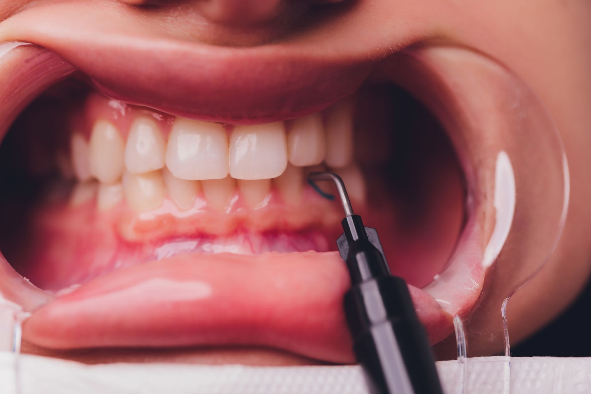 Primo piano di denti e gengive mentre uno strumento odontoiatrico pulisce un dente posteriore all'interno di una bocca aperta.