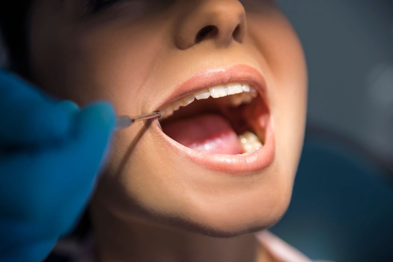 Primo piano di una visita odontoiatrica, con una mano guantata che utilizza uno specchietto dentale all'interno di una bocca aperta.