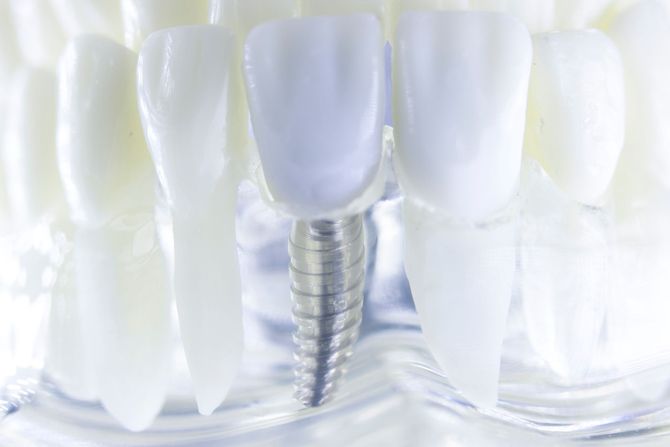 Impianto dentale tra denti artificiali bianchi, primo piano su una mandibola modello.