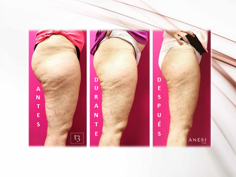 Elimina celulitis