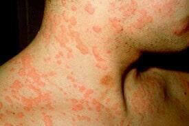 CLÍNICA EN ALERGIAS Y ASMA - ALERGIA EN LA PIEL