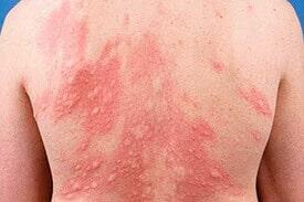 CLÍNICA EN ALERGIAS Y ASMA - ALERGIA POR MEDICAMNETO