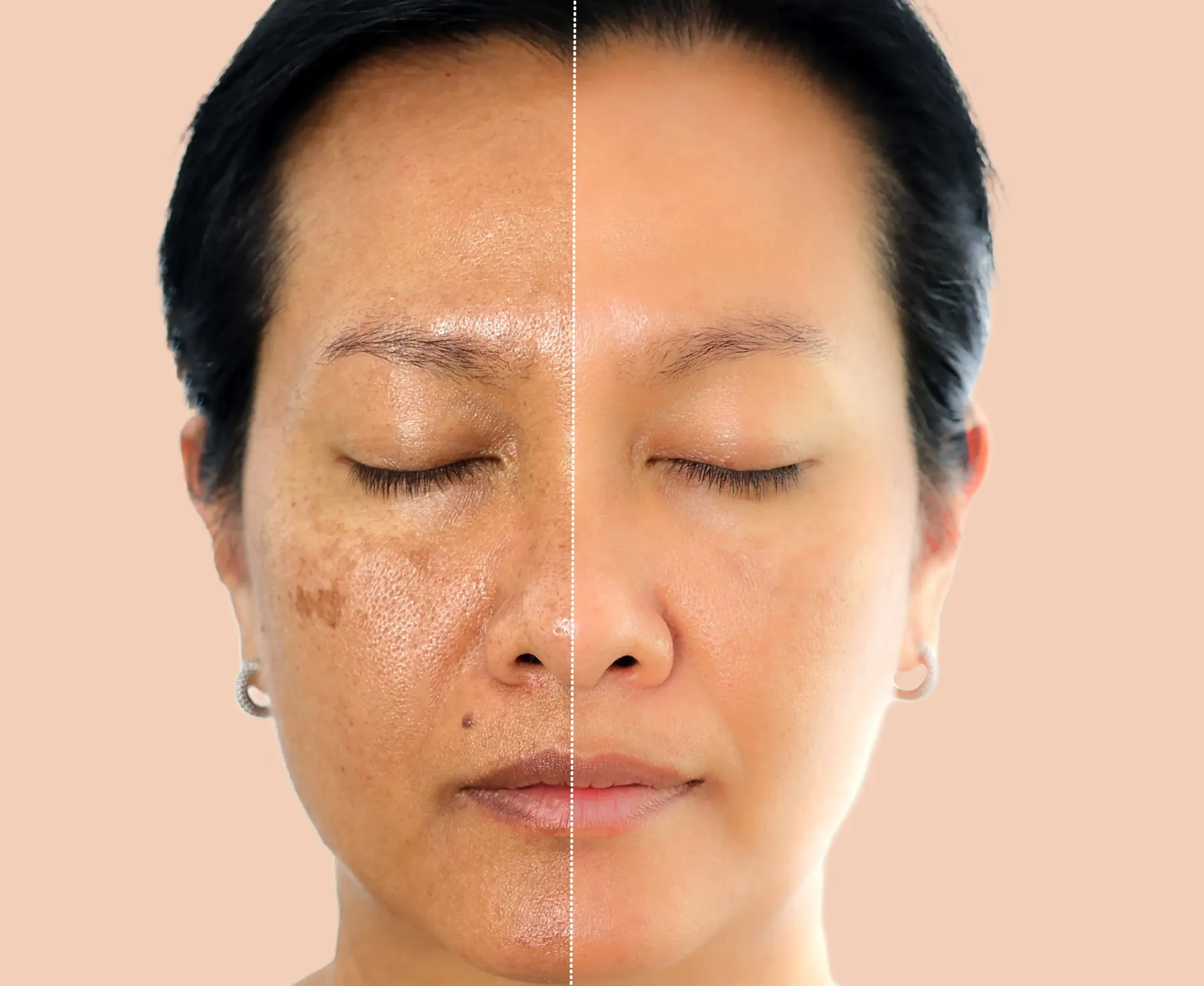 Close-up face with acne scars and spots, split down the center to show before and after skin treatment comparisons