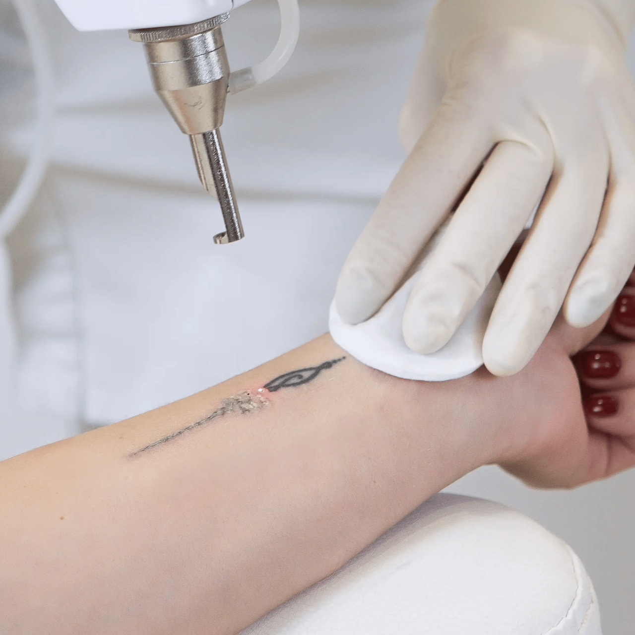 Gloved hand wipes skin near a small wrist tattoo during laser tattoo removal