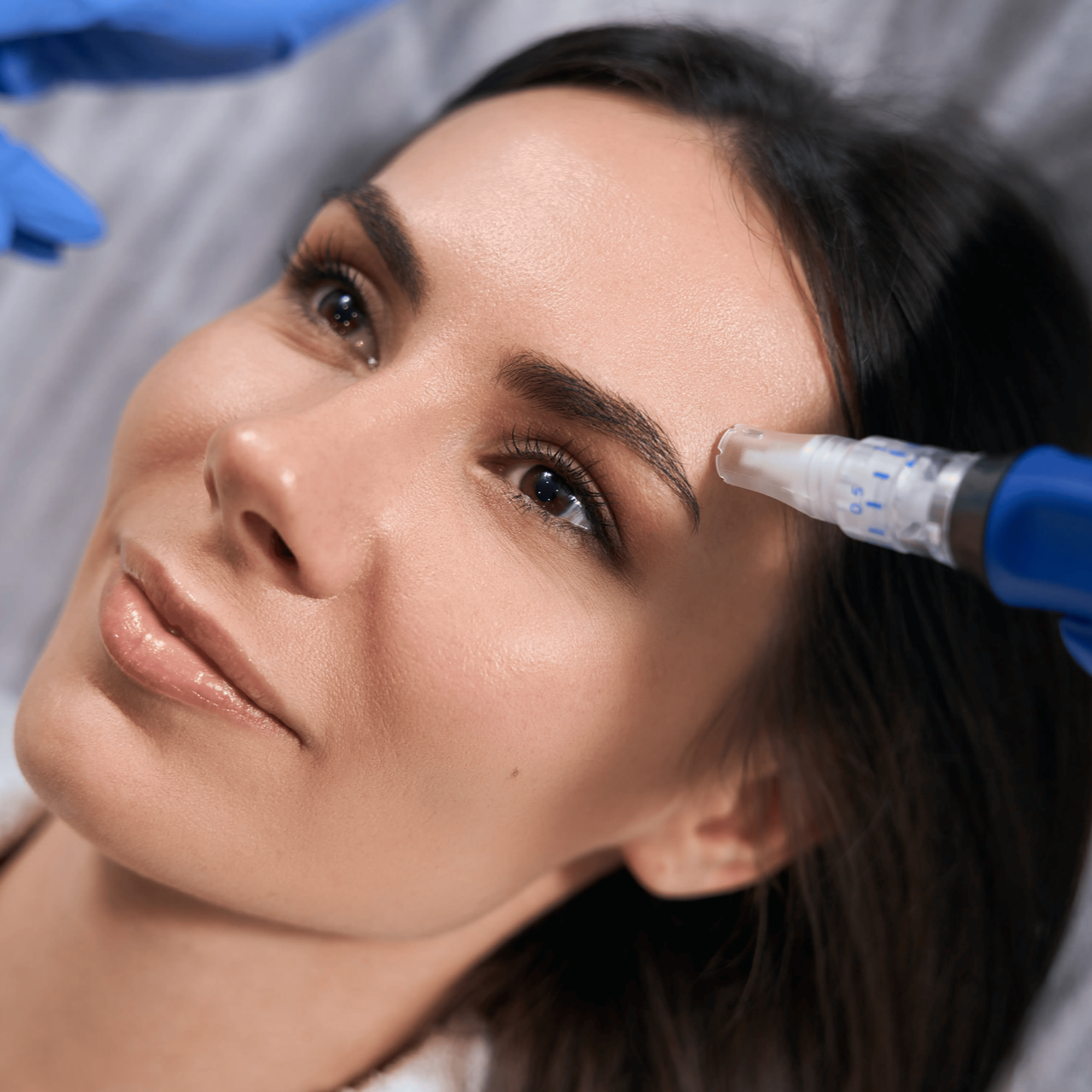 Cosmetic microneedling treatment on a woman’s forehead with a handheld device