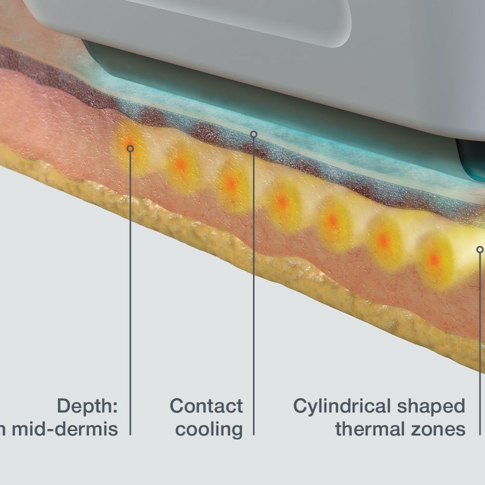 Diagram of device cooling skin, showing cylindrical thermal zones extending to the mid-dermis.