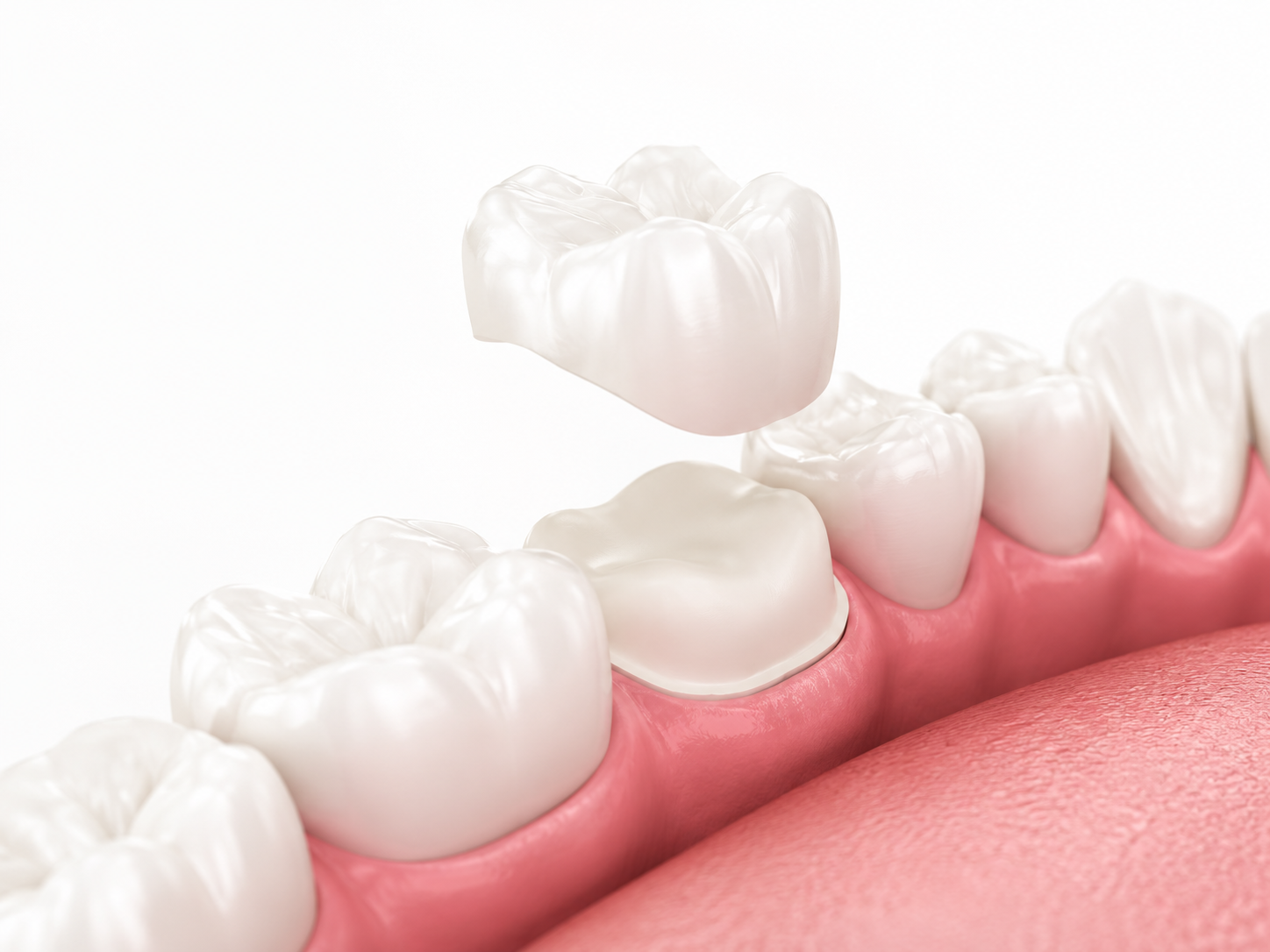 Close-up of white dental crowns being placed on pink gums