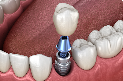 Dental implant process: A crown being placed on an abutment, atop an implant in a person’s mouth.