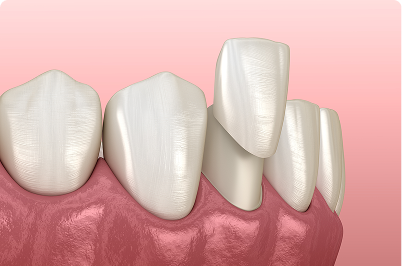 Illustration of a tooth with a dental veneer partially placed on the tooth, with healthy gums.