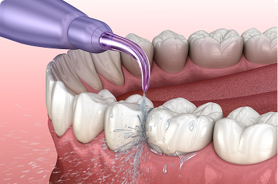 Dental cleaning illustration: A purple tool sprays water onto teeth, removing plaque.