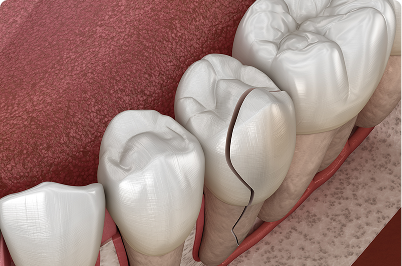 3D rendering of a cracked molar tooth. Shows a close-up of a damaged tooth with a visible vertical fracture.