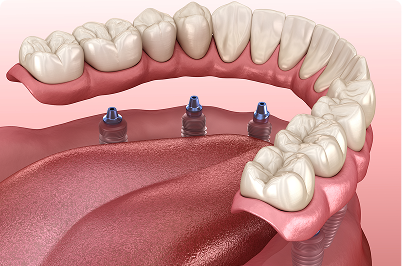 Dental illustration showing upper teeth supported by implants, in the mouth.