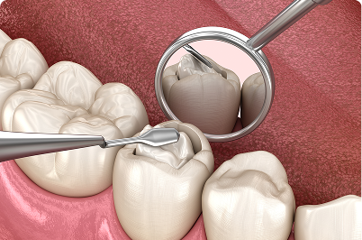 Dental tools examining a tooth filling. Mirror reflects the tooth. Pink gums visible.