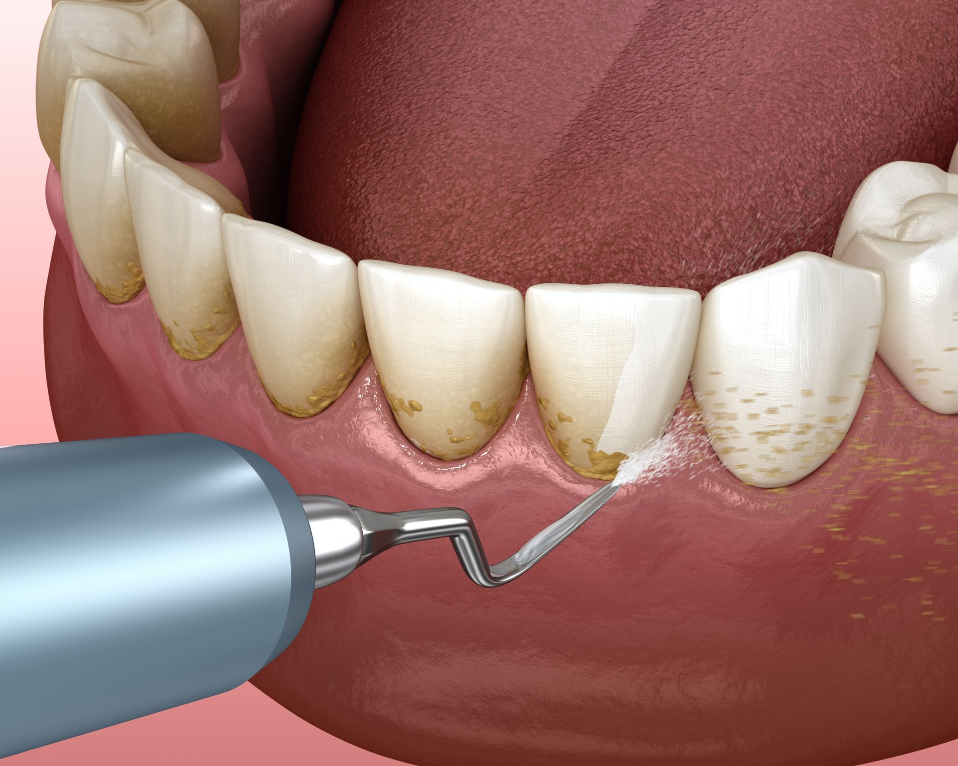 Dental hygienist using a scaler tool to remove plaque from teeth.