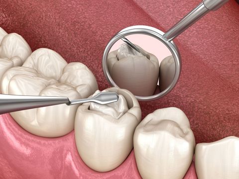 Dental tools inspecting a tooth filling. Mirror and tool in mouth, pink gums visible.