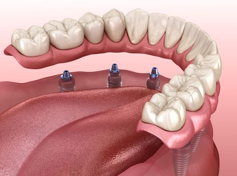 Dental model showing lower jaw with implants and attached bridge. Red gums and white teeth.