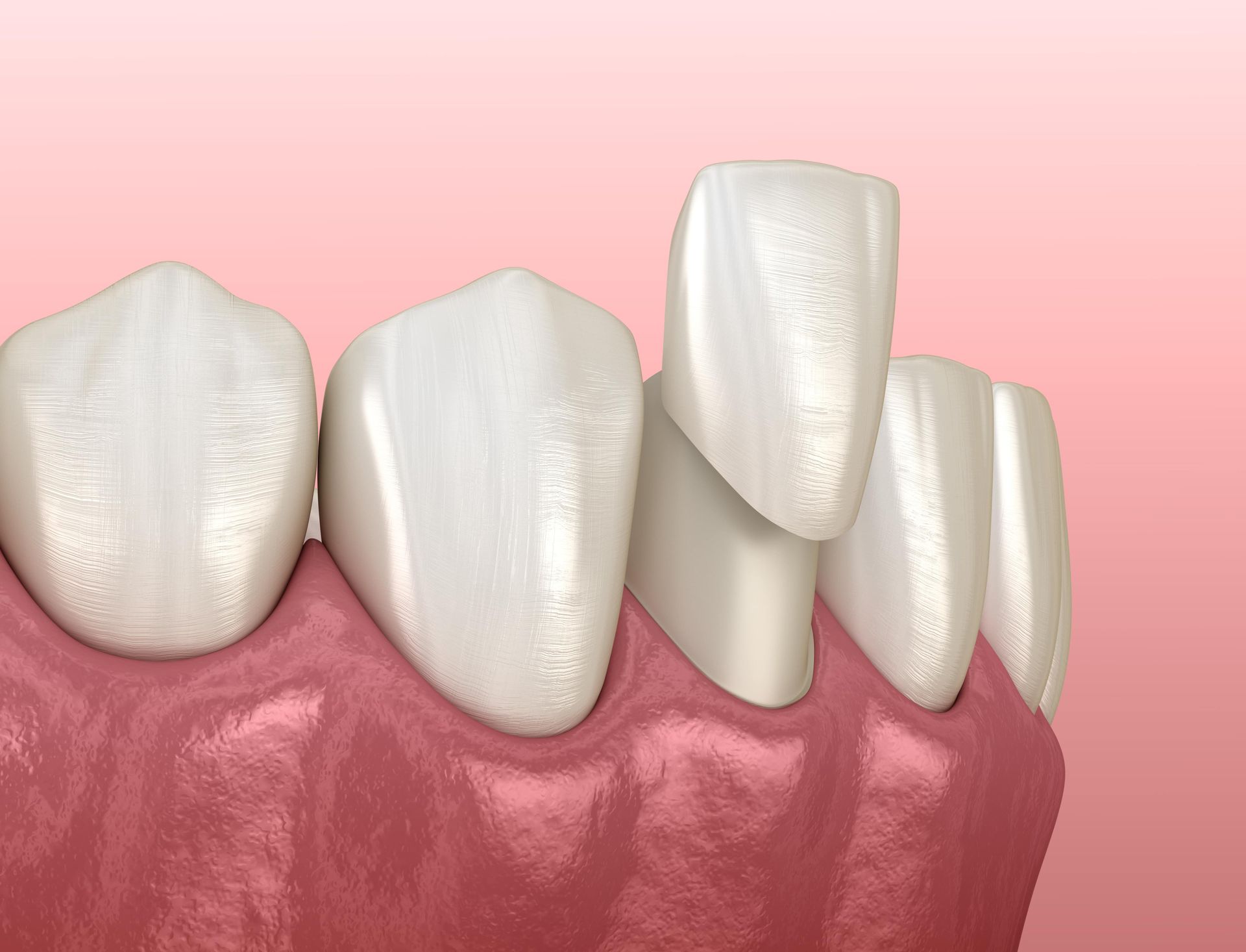 Dental veneers on teeth, pink gums, light pink background.