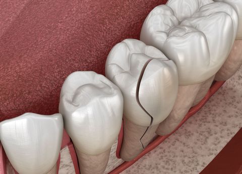 Close-up of teeth in a gumline. One tooth has a large vertical crack.
