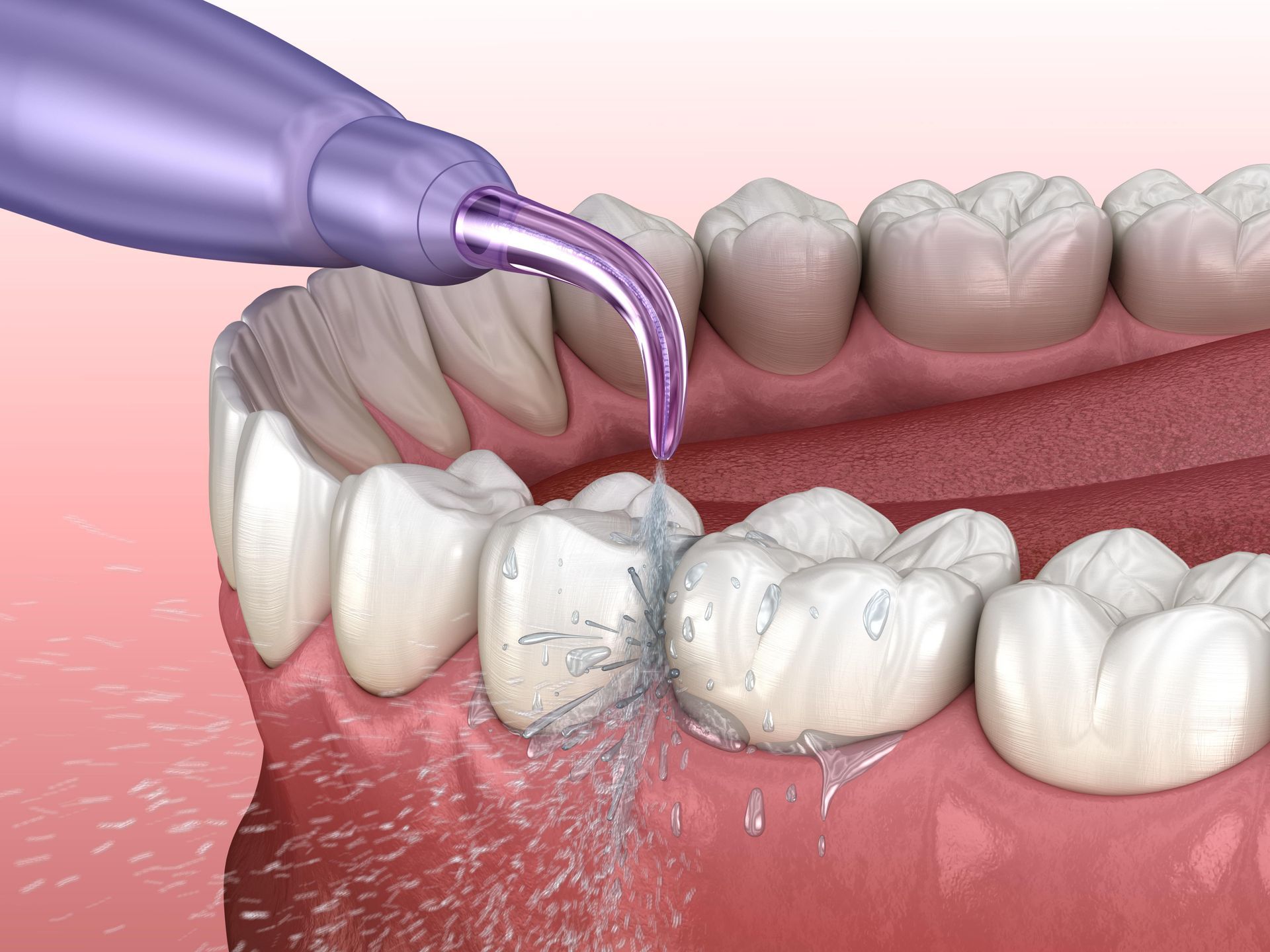 Dental hygienist using a water flosser to clean teeth; pink gums, white teeth, purple tool.