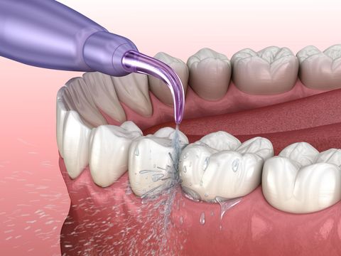 Dental hygienist using a water flosser on a patient's teeth; pink gums, white teeth, purple device.