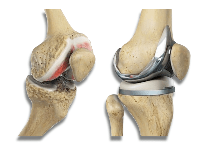 Prótese do joelho