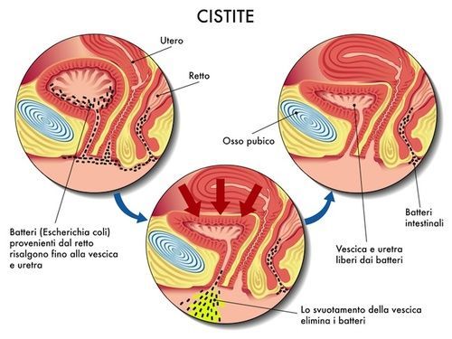 Meccanismo cistite. Immagine di ASM.