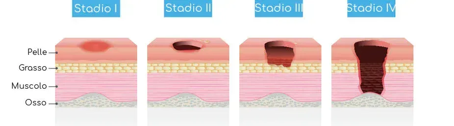 4 stadi delle piaghe da decubito