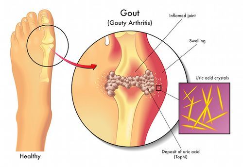 https://www.scienzintasca.it/gotta-e-iperuricemia/