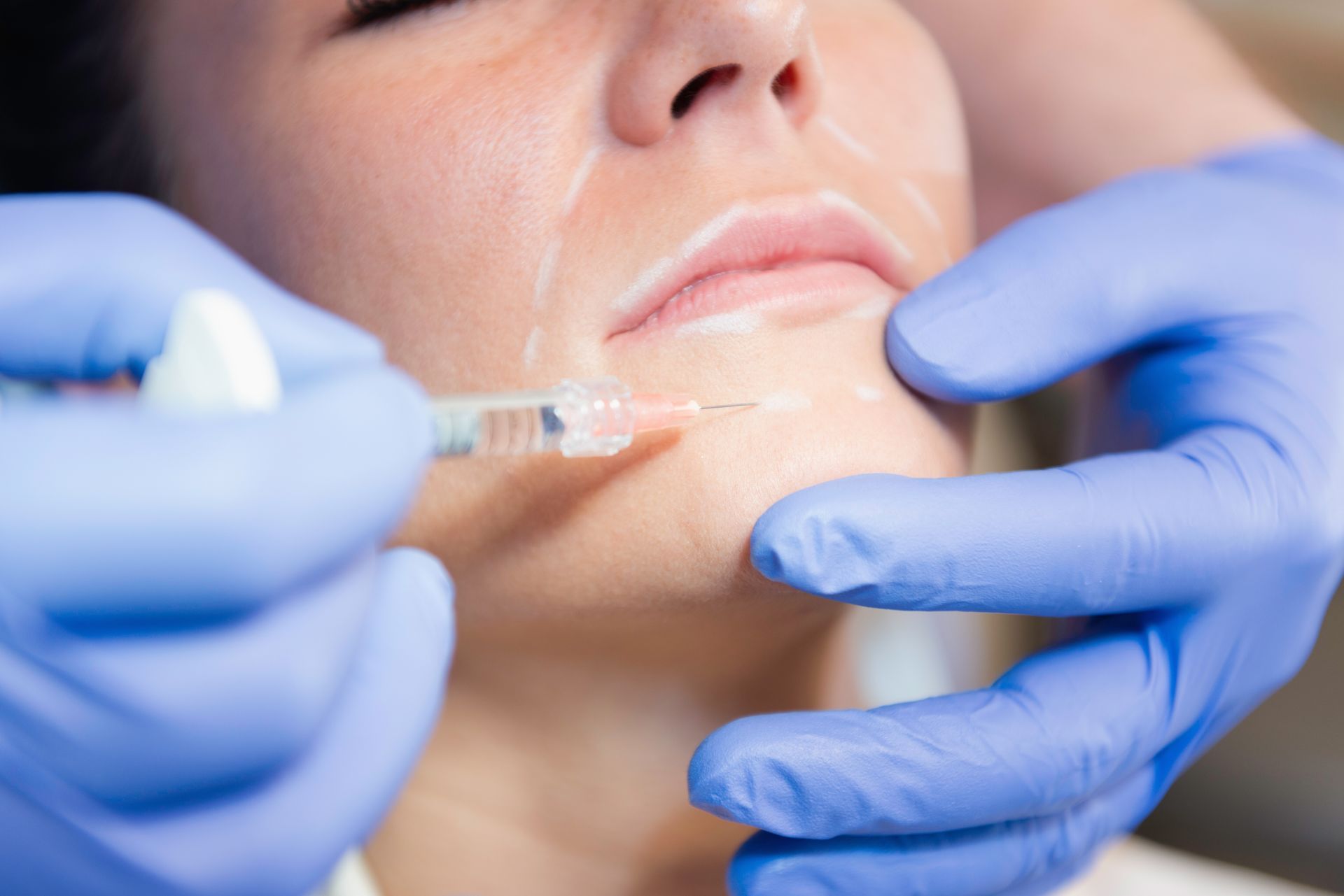 Eine Frau bekommt eine Botox-Injektion ins Gesicht.
