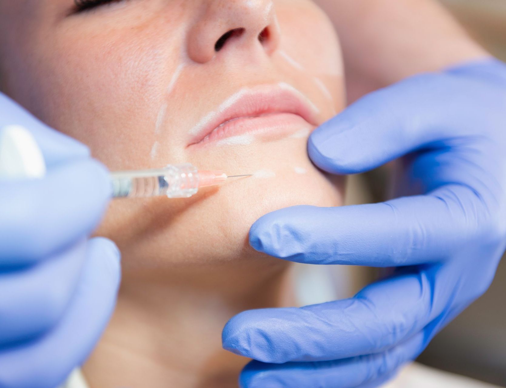 Eine Frau bekommt eine Botox-Injektion ins Gesicht.