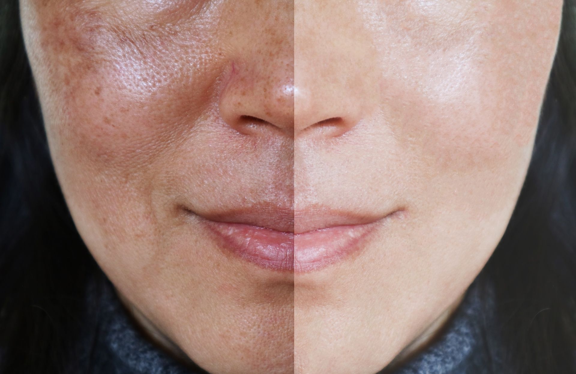 A black and white photo of a woman 's face with and without freckles.