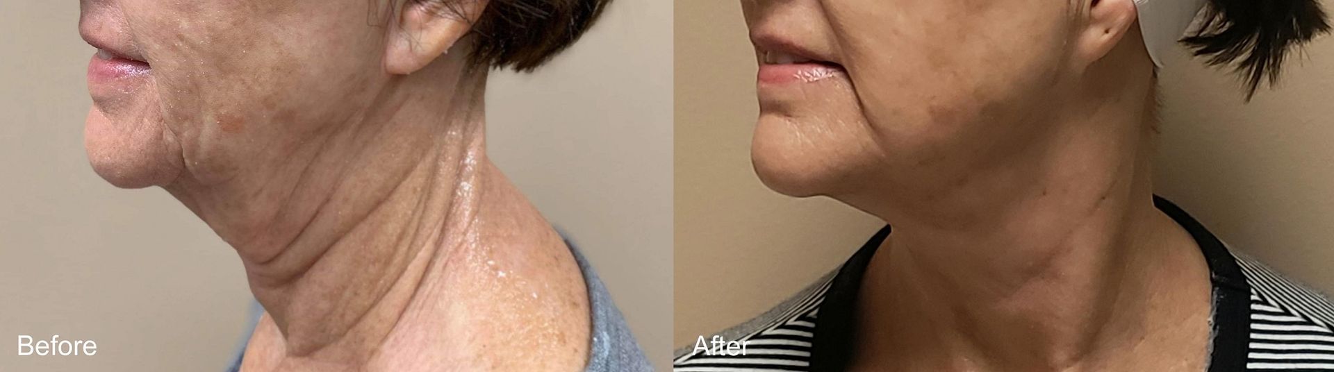 A before and after photo of a woman 's neck and face. A before and after photo of a woman 's neck and face.