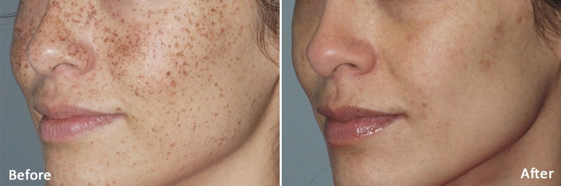 A before and after photo of a woman 's face A before and after photo of a woman 's face