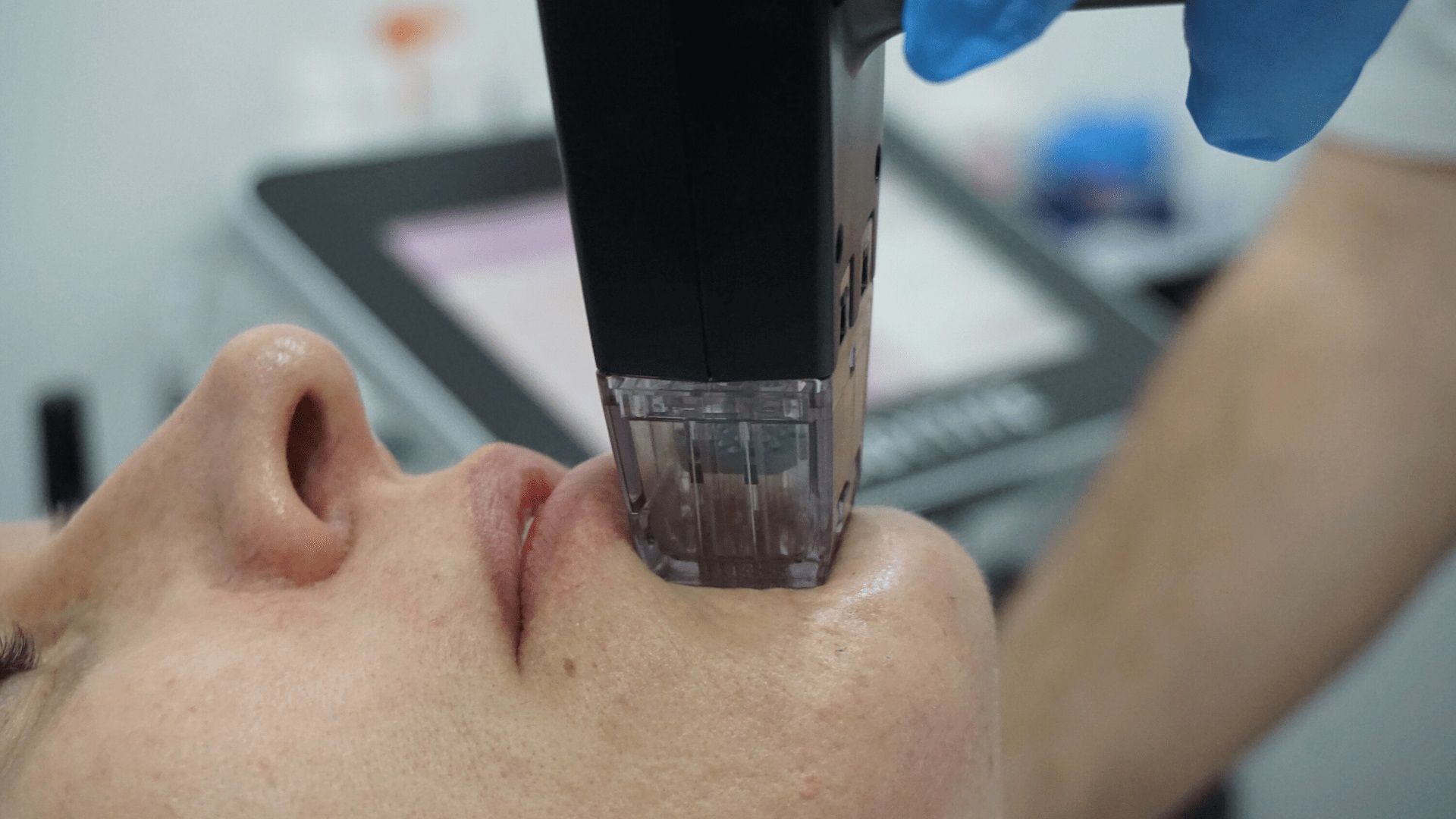 A black and white photo of a woman getting a laser treatment on her face. A black and white photo of a woman getting a laser treatment on her face.